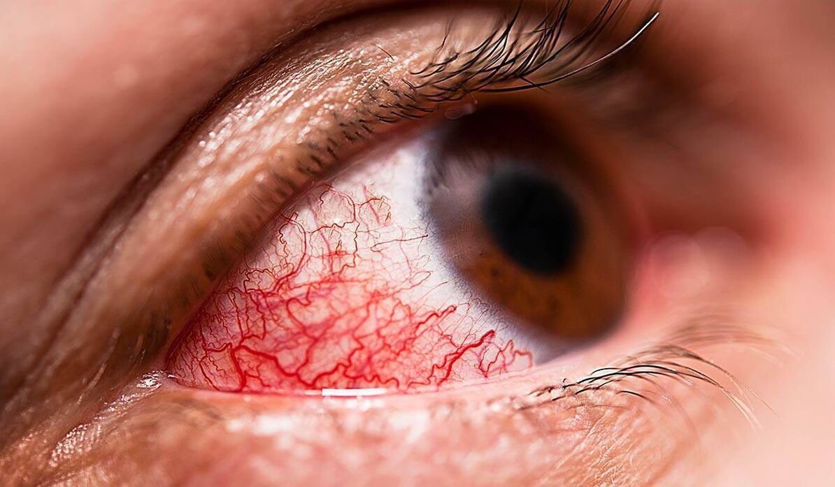 Diabeetiline retinopaatia on üks diabeedi hilinenud komplikatsioone